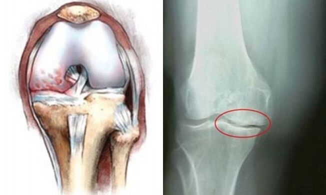 osteoarthritis of the knee x-ray