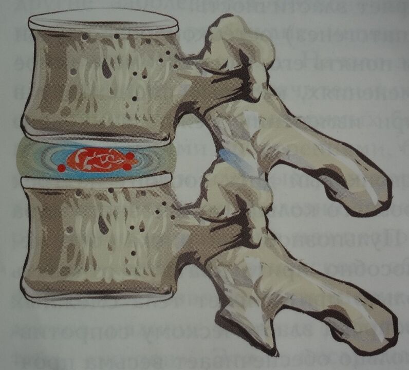 Damage to the nucleus pulposus of the intervertebral disc in the first stage of cervical osteochondrosis. 