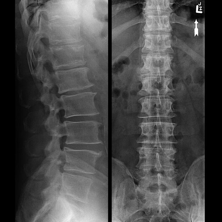 Spolling column with osteochondrosis