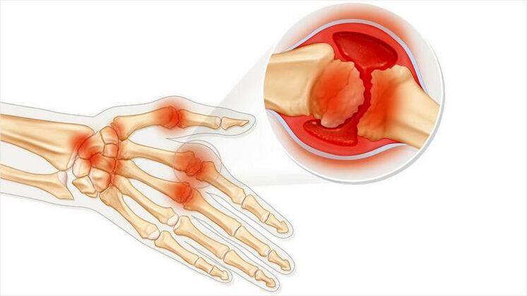 Damage to the joints of the hand due to arthritis.