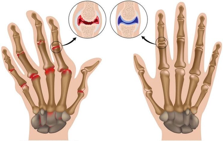 Healthy hand joints and joints damaged by osteoarthritis.