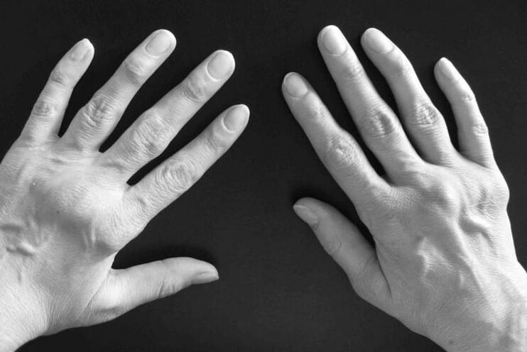 Symptoms of arthritis in the joints of the hands.