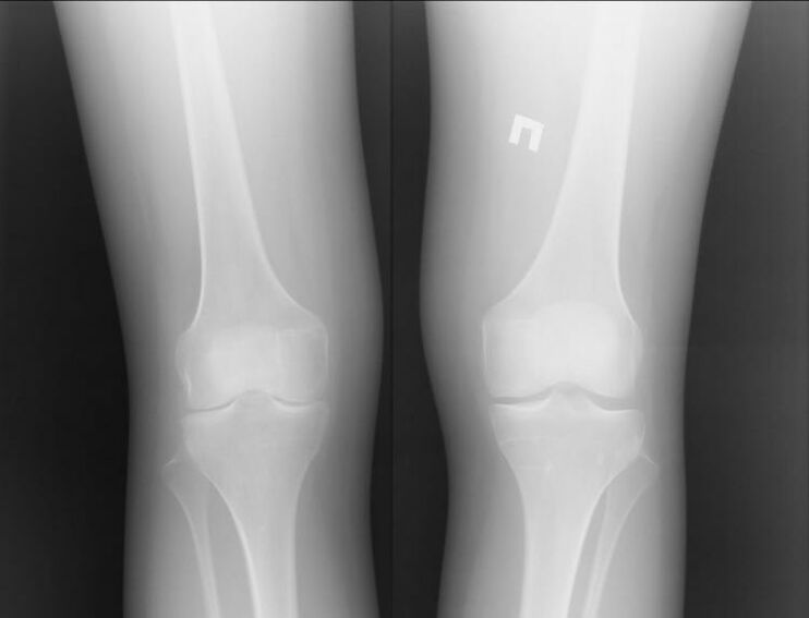 X-ray of knees affected by osteoarthritis.