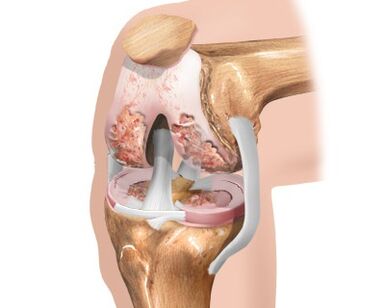 Destruction of the knee joint due to osteoarthritis.