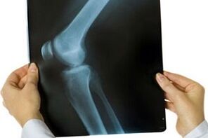 osteoarthritis of the knee joint on x-ray