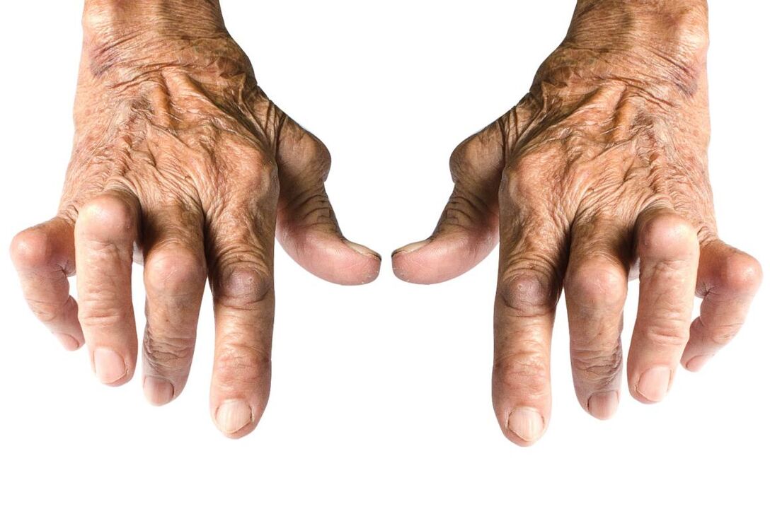 signs of arthritis - joint deformity